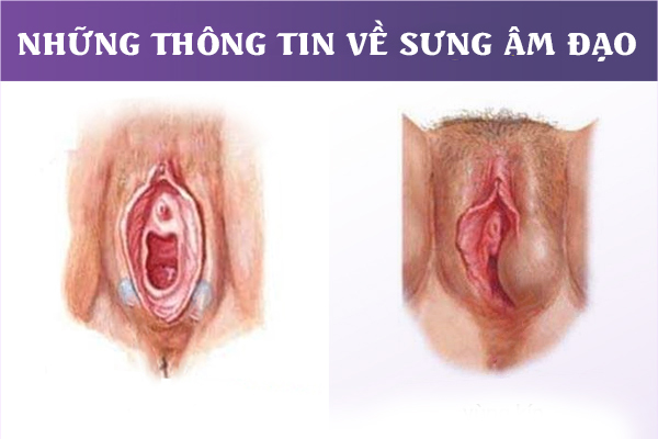 Những thông tin về bệnh sưng âm đạo