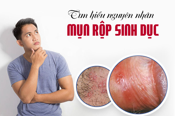Tìm hiểu nguyên nhân mụn rộp sinh dục